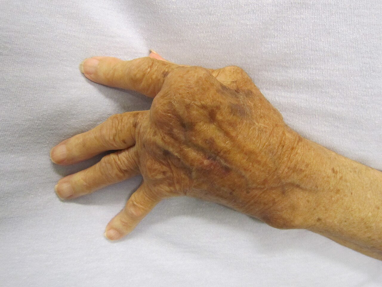 Yoga can bring relief for Rheumatoid Arthritis (RA) patients.